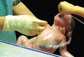 Tali Pusat atau Umbilical Cord Pada Bayi Baru Lahir